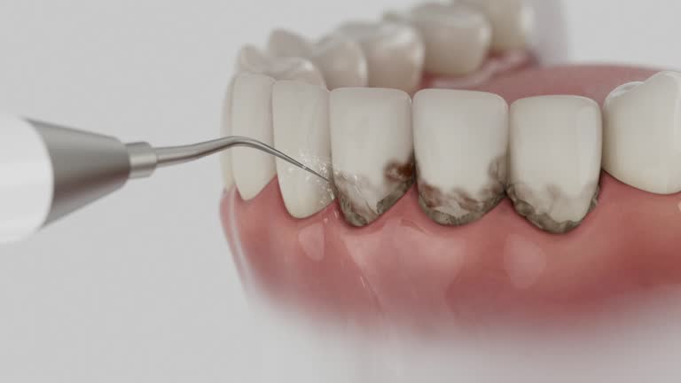 Reliable Dental Implants contractor in Delray Beach, FL by Smile Center Dentistry